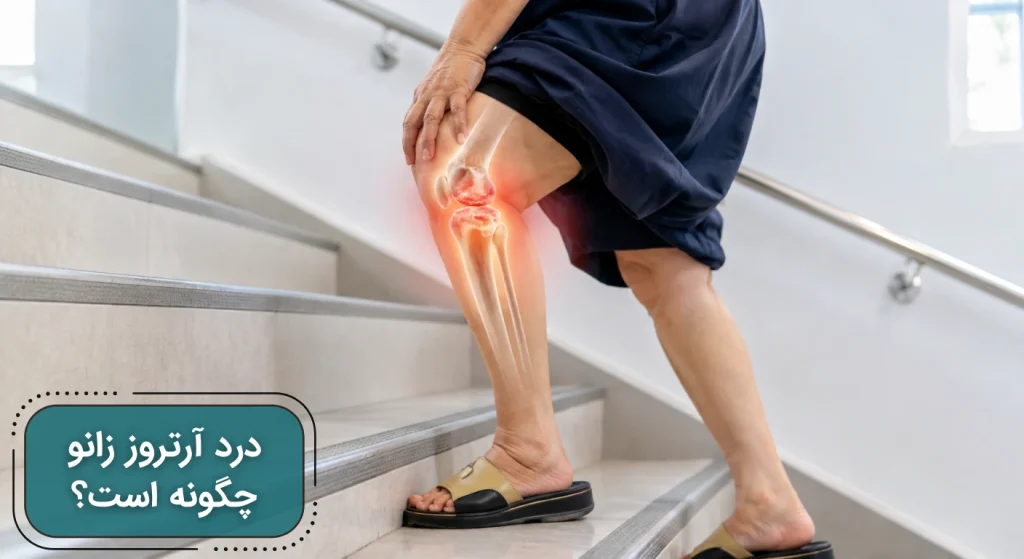 درد آرتروز زانو چگونه است؟ | تصویری از زانوی یک فرد مبتلا به درد زانو در حال بالا رفتن از پله